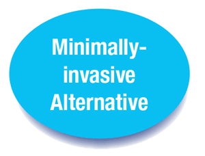 Minimally-invasive Alternative