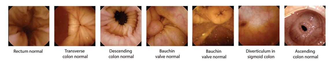 NaviCam Colon System